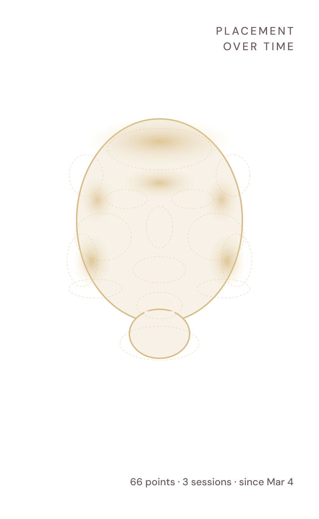 Placement over time: three sessions of mapped points shown as gold heat on a face map